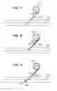 Fig. 05 - Intravenous deep vein thrombosis filter and method of filter placement