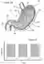 Fig. 02 - PROCESS FOR ELECTROSTIMULATION TREATMENT OF MORBID OBESITY