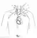 Fig. 02 - Spiral configurations for intravascular lead stability