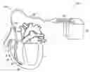 Fig. 01 - FIBROSIS-LIMITING MATERIAL ATTACHMENT