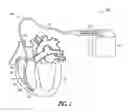 Fig. 02 - FIBROSIS-LIMITING MATERIAL ATTACHMENT
