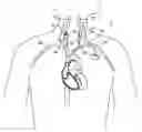 Fig. 01 - ELECTRODE CONFIGURATIONS FOR TRANSVASCULAR NERVE STIMULATION