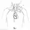 Fig. 02 - ELECTRODE CONFIGURATIONS FOR TRANSVASCULAR NERVE STIMULATION