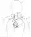 Fig. 01 - TRANSVASCULAR LEAD WITH PROXIMAL FORCE RELIEF