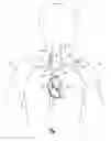 Fig. 02 - TRANSVASCULAR LEAD WITH PROXIMAL FORCE RELIEF