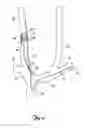 Fig. 03 - TRANSVASCULAR LEAD WITH PROXIMAL FORCE RELIEF