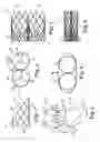 Fig. 02 - Stented heart valve devices and methods for atrioventricular valve replacement