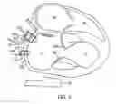 Fig. 08 - APPARATUSES AND METHODS FOR PERFORMING MINIMALLY INVASIVE DIAGNOSTIC AND SURGICAL PROCEDURES INSIDE OF A BEATING HEART