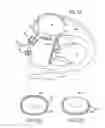 Fig. 22 - APPARATUSES AND METHODS FOR PERFORMING MINIMALLY INVASIVE DIAGNOSTIC AND SURGICAL PROCEDURES INSIDE OF A BEATING HEART