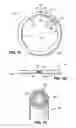 Fig. 02 - ADJUSTABLE CARDIAC VALVE IMPLANT WITH SELECTIVE DIMENSIONAL ADJUSTMENT