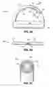 Fig. 04 - ADJUSTABLE CARDIAC VALVE IMPLANT WITH SELECTIVE DIMENSIONAL ADJUSTMENT