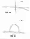 Fig. 09 - ADJUSTABLE CARDIAC VALVE IMPLANT WITH SELECTIVE DIMENSIONAL ADJUSTMENT