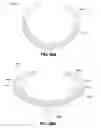 Fig. 22 - ADJUSTABLE CARDIAC VALVE IMPLANT WITH SELECTIVE DIMENSIONAL ADJUSTMENT