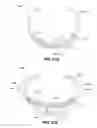 Fig. 23 - ADJUSTABLE CARDIAC VALVE IMPLANT WITH SELECTIVE DIMENSIONAL ADJUSTMENT