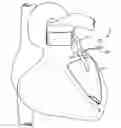 Fig. 01 - Devices and methods for absorbing, transferring and delivering heart energy