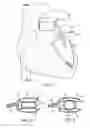 Fig. 02 - Devices and methods for absorbing, transferring and delivering heart energy