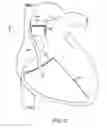 Fig. 04 - Devices and methods for absorbing, transferring and delivering heart energy