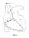Fig. 06 - Devices and methods for absorbing, transferring and delivering heart energy