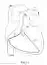 Fig. 10 - Devices and methods for absorbing, transferring and delivering heart energy