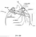 Fig. 30 - Orthovoltage radiotherapy