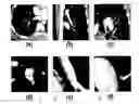 Fig. 01 - System and method for computer aided detection of pulmonary embolism in tobogganing in CT angiography