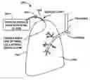Fig. 01 - Device and method for creating a localized pleurodesis and treating a lung through the localized pleurodesis
