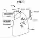 Fig. 02 - Device and method for creating a localized pleurodesis and treating a lung through the localized pleurodesis