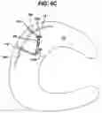 Fig. 09 - Methods and devices for repairing tissue