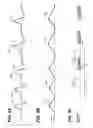 Fig. 05 - Device and method for treating disorders of the cardiovascular system or heart