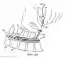 Fig. 15 - Apparatus for implanting an electrical stimulation lead
