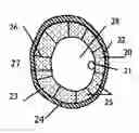 Fig. 01 - ENDOVASCULAR DEVICES TO PROTECT ANEURYSMAL WALL