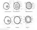 Fig. 02 - ENDOVASCULAR DEVICES TO PROTECT ANEURYSMAL WALL
