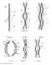 Fig. 04 - ENDOVASCULAR DEVICES TO PROTECT ANEURYSMAL WALL