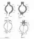 Fig. 16 - ENDOVASCULAR DEVICES TO PROTECT ANEURYSMAL WALL
