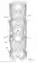 Fig. 04 - Hybrid stent and method of making