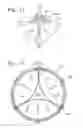 Fig. 08 - Methods of implanting two-part heart valves