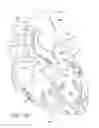 Fig. 09 - Methods of implanting two-part heart valves