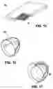 Fig. 11 - Methods of making shaped load-bearing osteoimplant