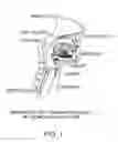 Fig. 02 - Methods and devices for treating sleep apnea and snoring