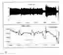 Fig. 02 - Method and apparatus for diagnosing respiratory disorders and determining the degree of exacerbations