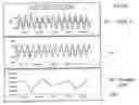 Fig. 09 - Method and apparatus for diagnosing respiratory disorders and determining the degree of exacerbations