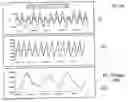 Fig. 10 - Method and apparatus for diagnosing respiratory disorders and determining the degree of exacerbations