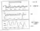 Fig. 11 - Method and apparatus for diagnosing respiratory disorders and determining the degree of exacerbations