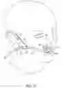 Fig. 15 - Nasal and oral patient interface