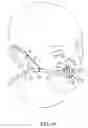 Fig. 26 - Nasal and oral patient interface