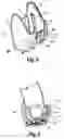 Fig. 07 - Adapter shoe and a combination of adapter shoe and hearing aid