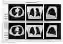 Fig. 01 - Visual enhancement of interval changes using temporal subtraction and pattern detector