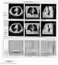 Fig. 04 - Visual enhancement of interval changes using temporal subtraction and pattern detector