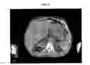 Fig. 18 - Radiolabeled Nanohybrids Targeting Solid Tumor Neovasculature and Method of Using Same