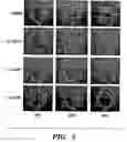 Fig. 06 - Method to treat and prevent posterior capsule opacification